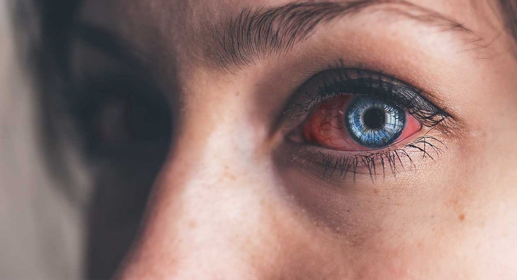 دوره درمان عفونت ویروسی چشم
