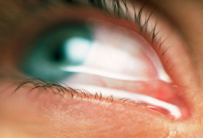 نکاتی برای کمک به مقابله با آلرژی چشم