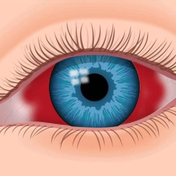 علت خونریزی سفیدی چشم