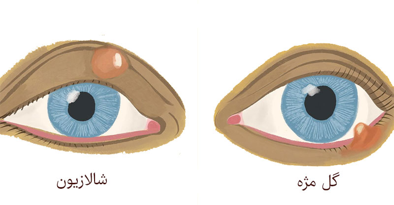 همه چیز درباره شالازیون چشم