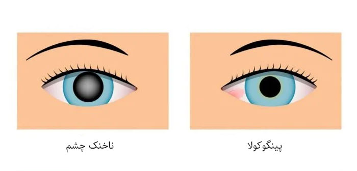 تفاوت پینگوکولا و ناخنک چشم