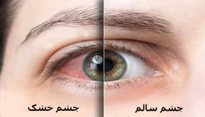 عوارض درمان نکردن خشکی چشم