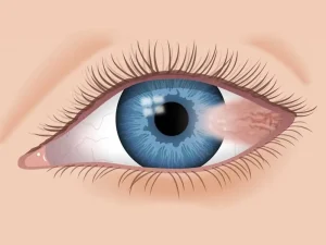 ناخنک چشم چیست؟