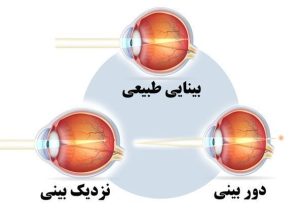 کدام عیوب انکساری خطرناک است؟