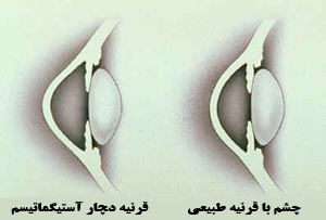  علامت رایج آستیگماتیسم چیست؟
