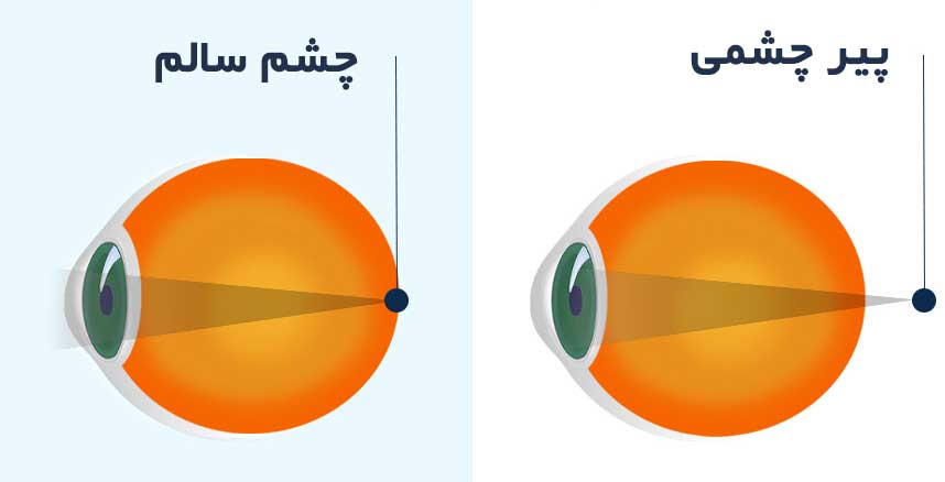 پیرچشمی چیست؟ آیا پیرچشمی قابل درمان است؟