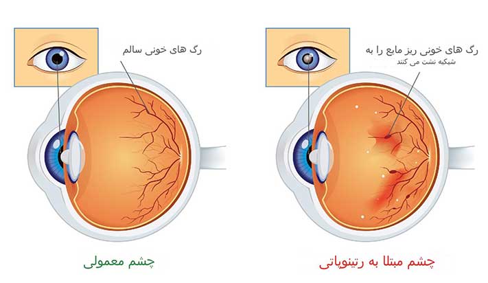 دیابت چگونه بر چشم تأثیر می‌گذارد؟