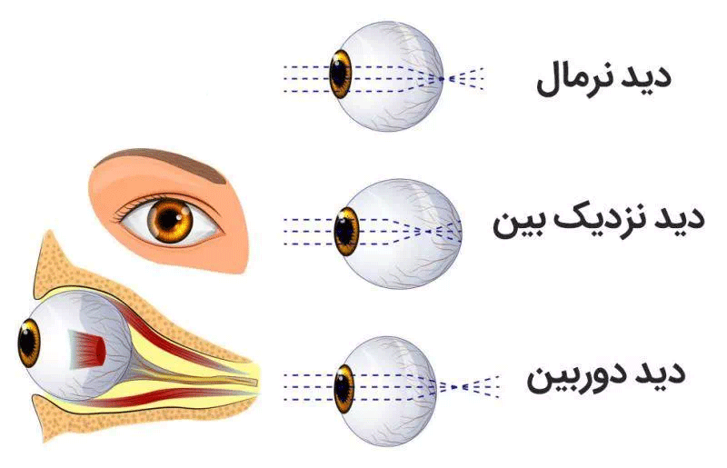 تفاوت بین نزدیک بینی و دوربینی چیست؟