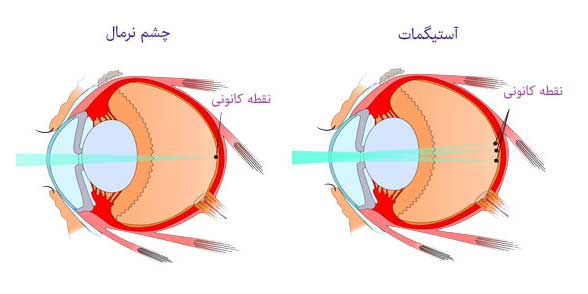 آیا افراد با چشم های آستیگمات می توانند از لنزهای تماسی استفاده کنند؟