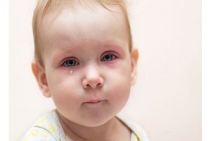 علائم آبریزش چشم