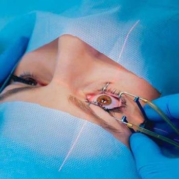 اهمیت استفاده از عینک ­آفتابی پس از لازک