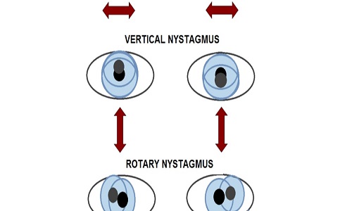 شایع ترین نوع بیماری نیستاگموس چیست