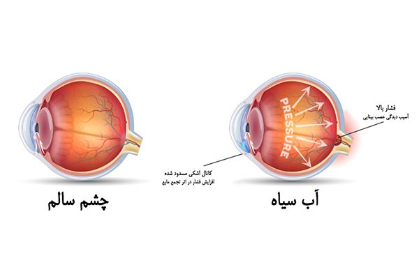 آیا آب سیاه باعث کوری می شود؟