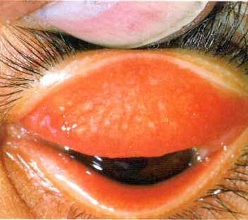 درمان بیماری تراخم چشم