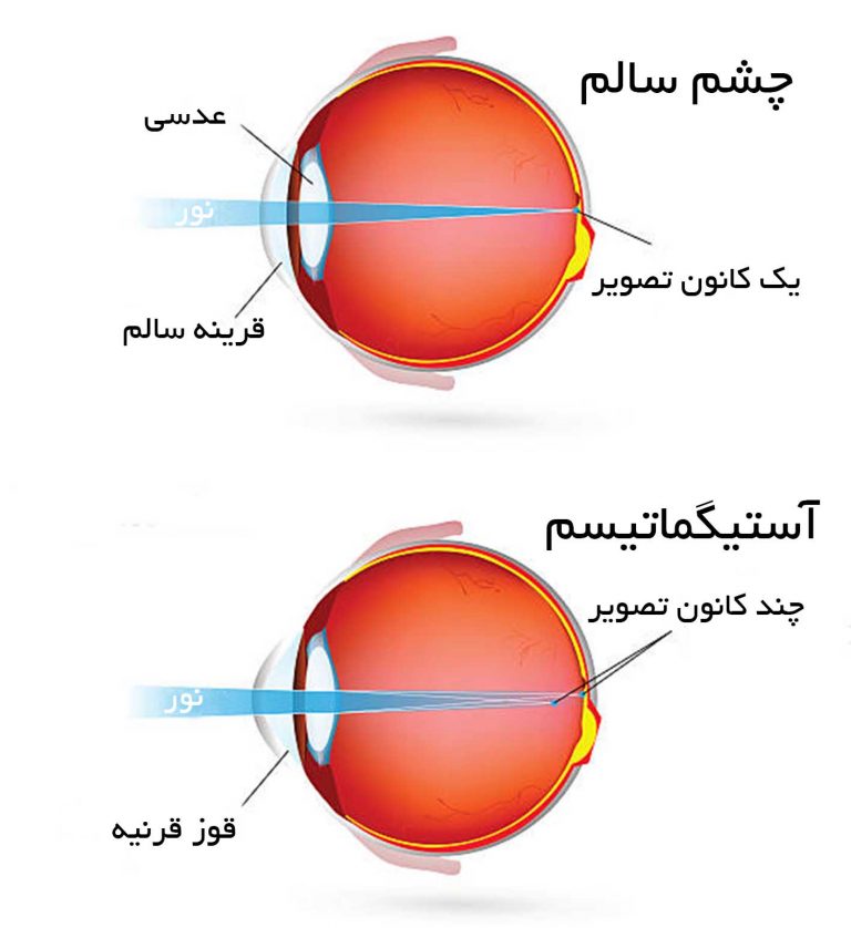 کدام لنز برای اصلاح آستیگماتیسم مناسب است؟