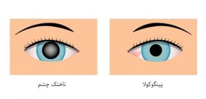 تفاوت پینگوکولا و ناخنک چشم