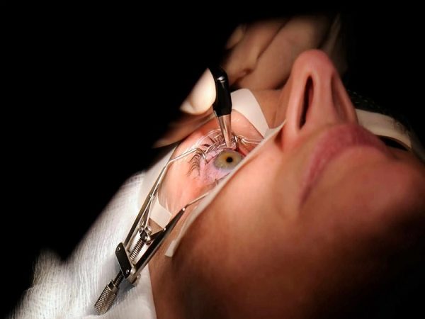 آیا بعد از عمل لیزیک چشم ضعیف می شود؟