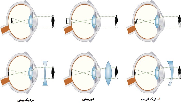 عیوب انکساری چشم