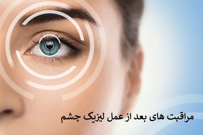 مراقبت چشم بعد از عمل لیزیک