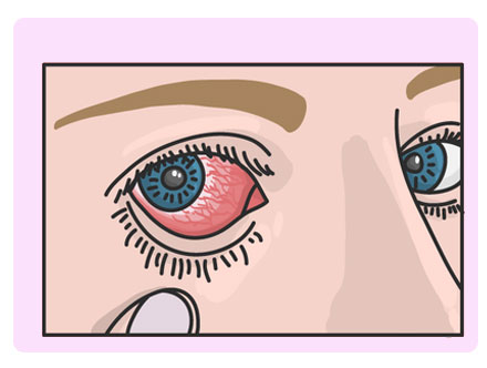 بیماری بهجت چشم چیست؟