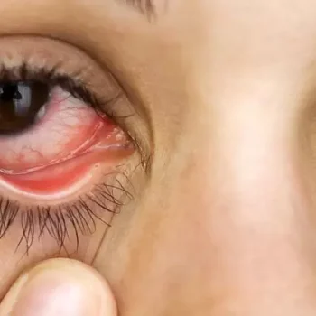 علت روماتیسم چشمی