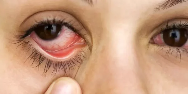 علت روماتیسم چشمی